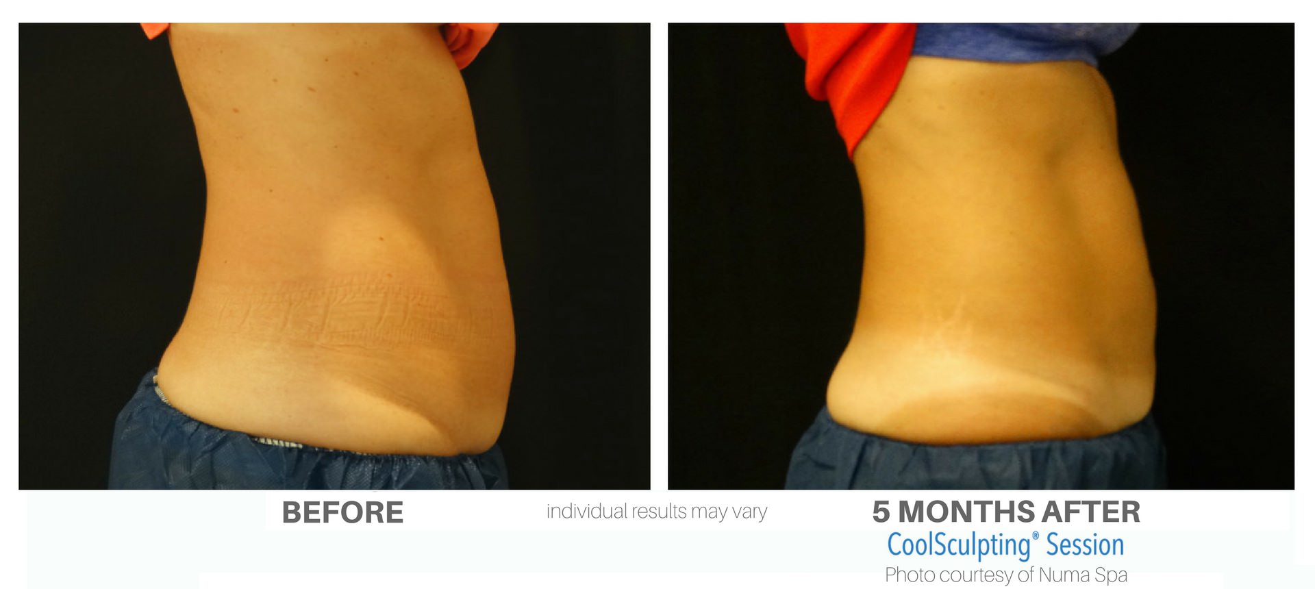 numa-coolsculpting-before-and-after