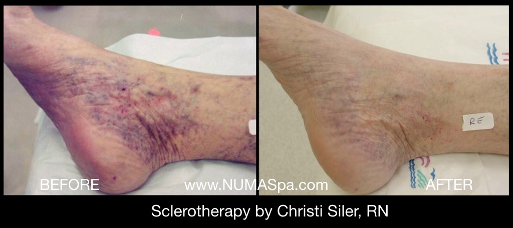 Sclerotherapy before and after in Newport News, VA