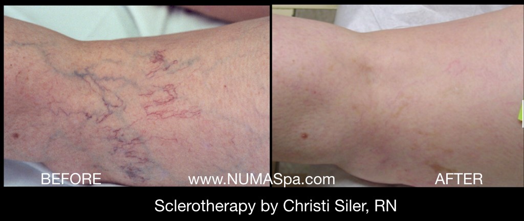 Sclerotherapy before and after in Numa Spa Newport News