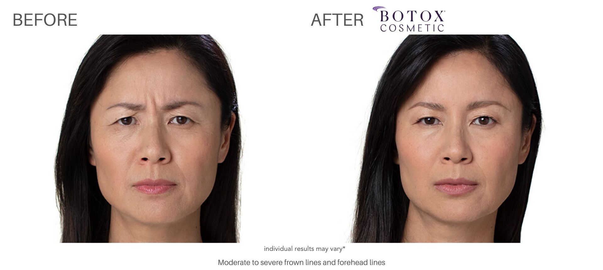 Botox before and after Numa Spa in Newport News, VA