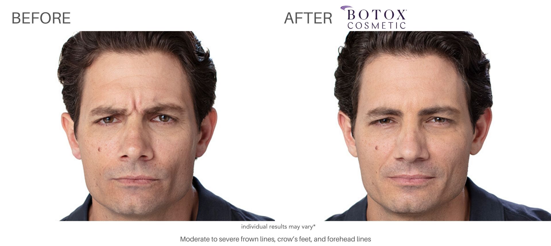 Botox Cosmetics before and after Numa Spa in Newport News, VA