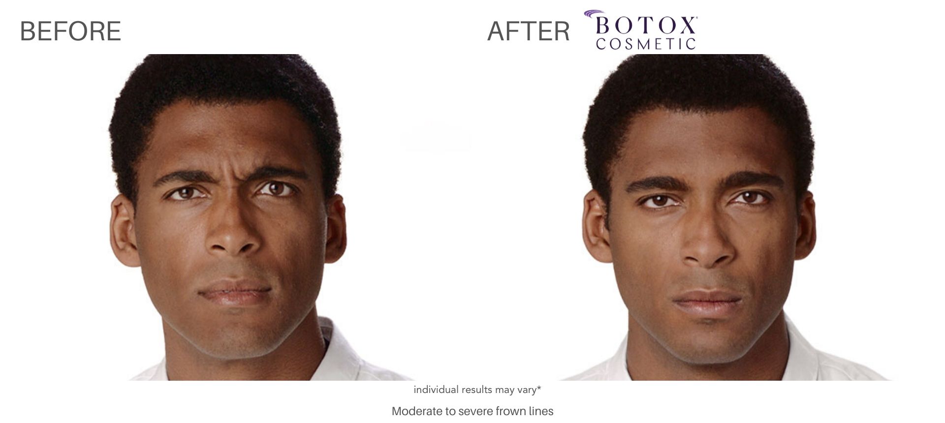 Botox before and after male result Numa Spa in Newport News, VA