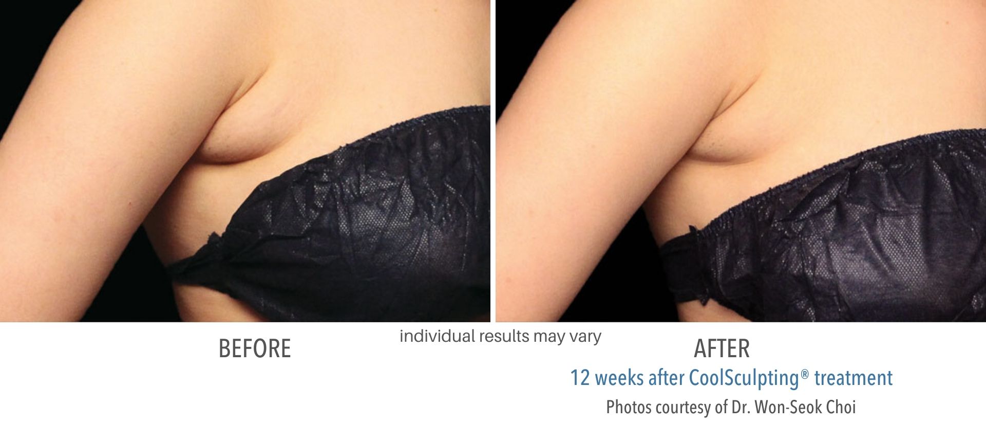 coolsculpting before and after results armpit fat Numa Spa