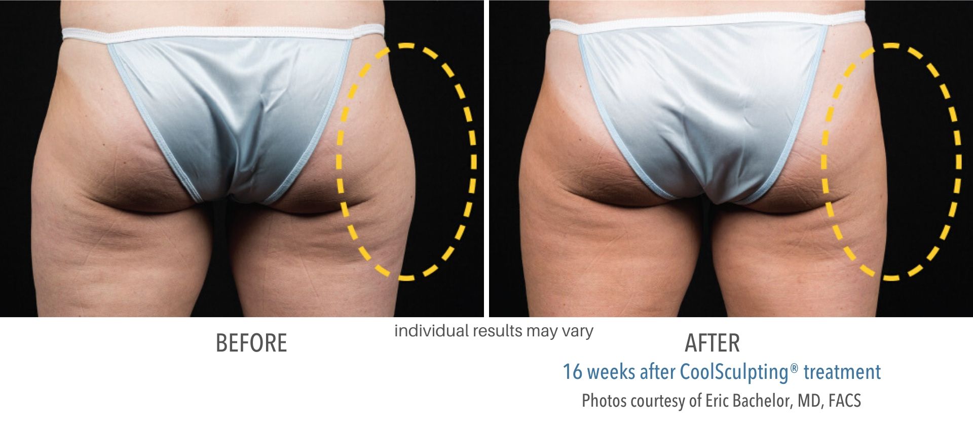 coolsculpting before and after results outer thigh Numa Spa