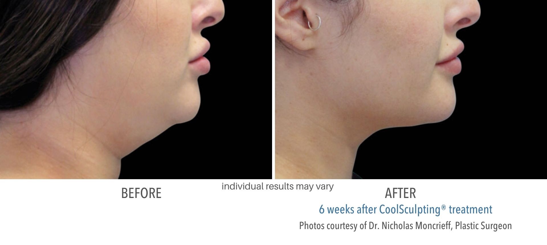 coolsculpting before and after results female double chin Numa Spa