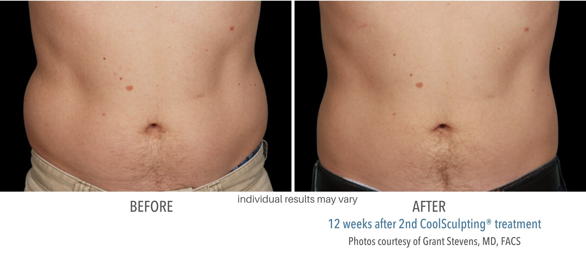 coolsculpting before and after results male abdomen Numa Spa