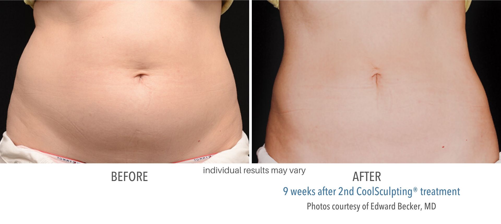 coolsculpting before and after results female stomach Numa Spa