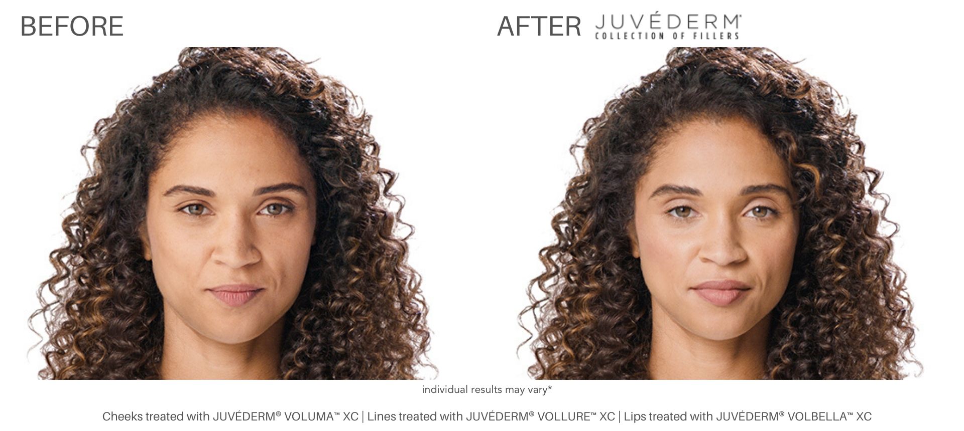 Juvederm Fillers before and after Numa Spa in Newport News, VA