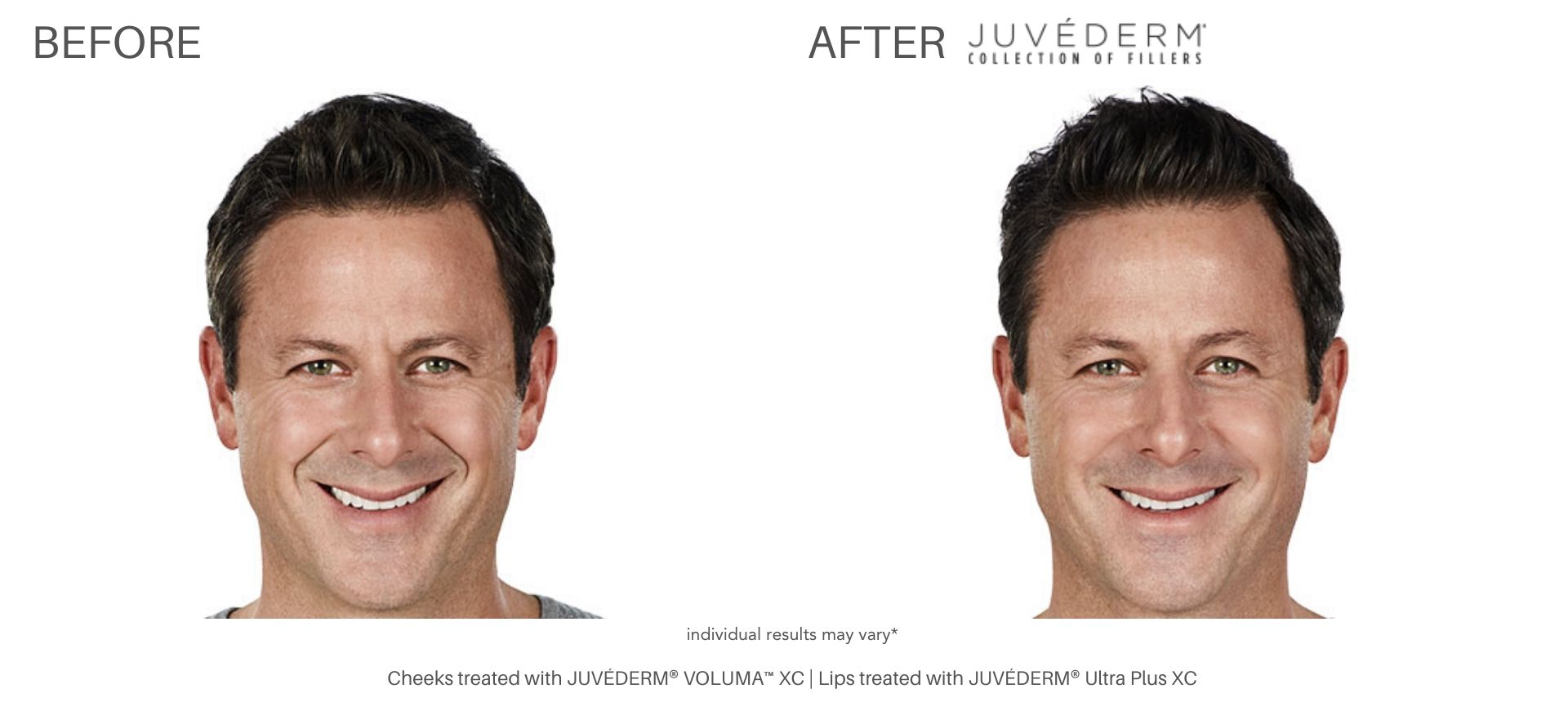 Juvederm Dernmal Fillers before and after Numa Spa in Newport News, VA