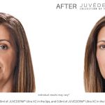 restore the skin's natural volume with Juvéderm at Numa Spa