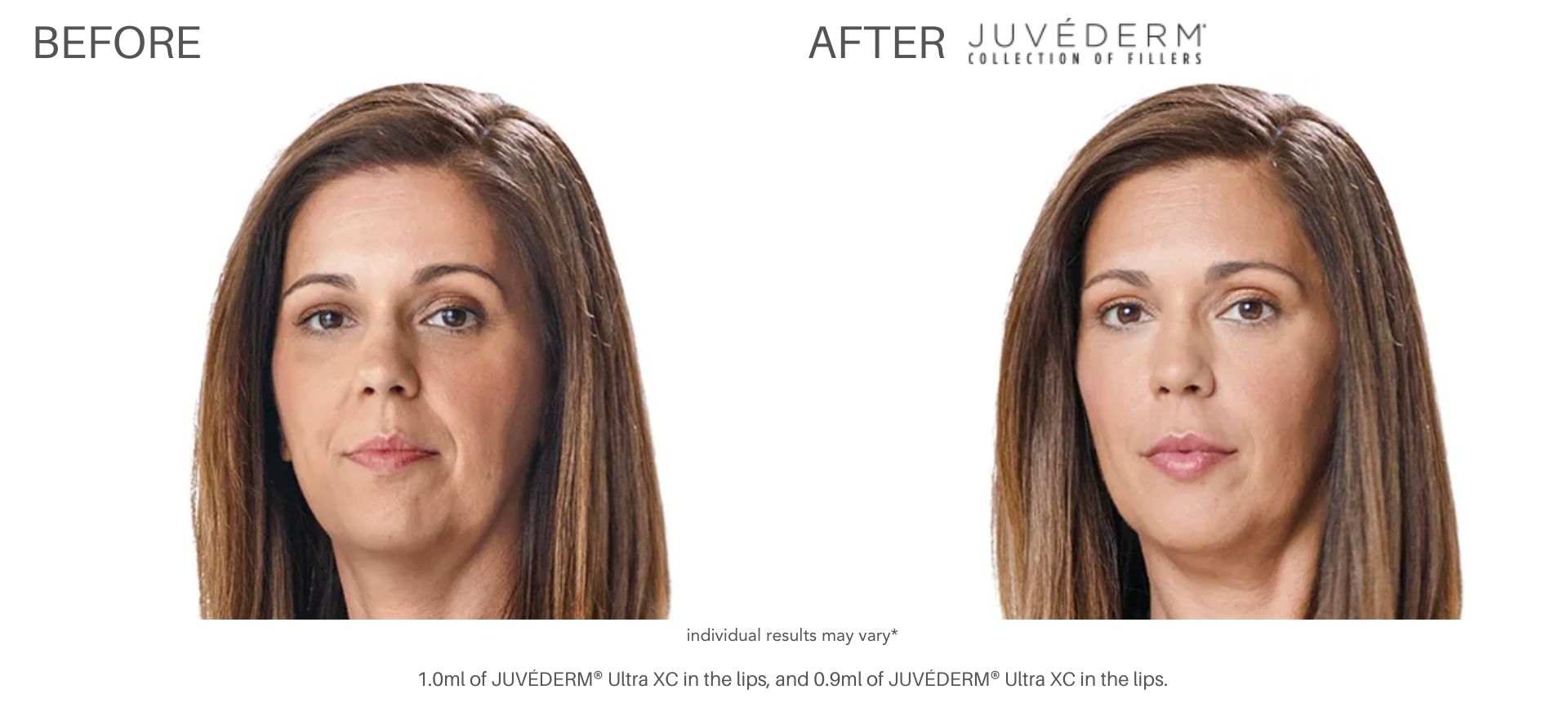 restore the skin's natural volume with Juvéderm at Numa Spa