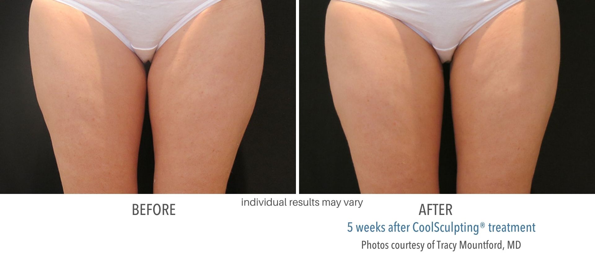 coolsculpting treatment for thigh