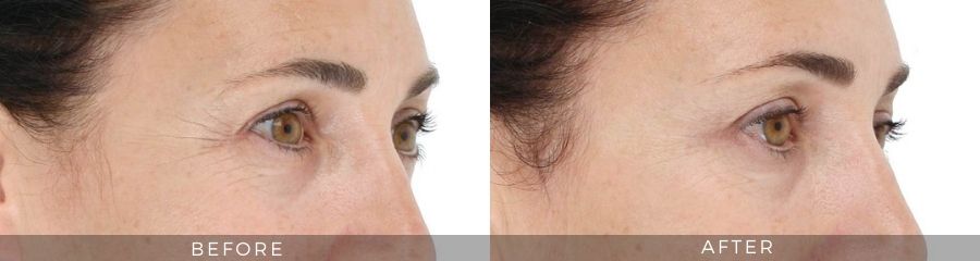 woman with crows feet after treated with LightStim Led Light Therapy