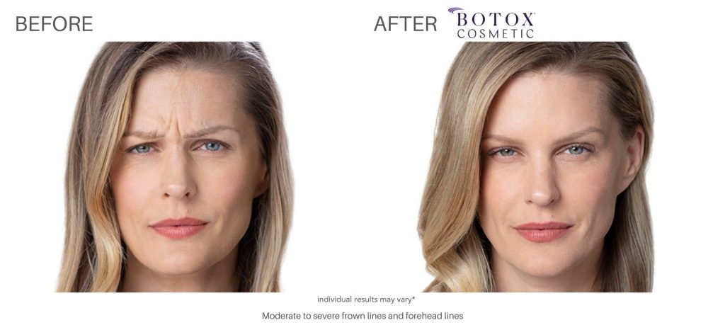 botox_before_and_after_result_numaspa_newportnews_1