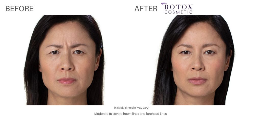botox_before_and_after_result_numaspa_newportnews_2
