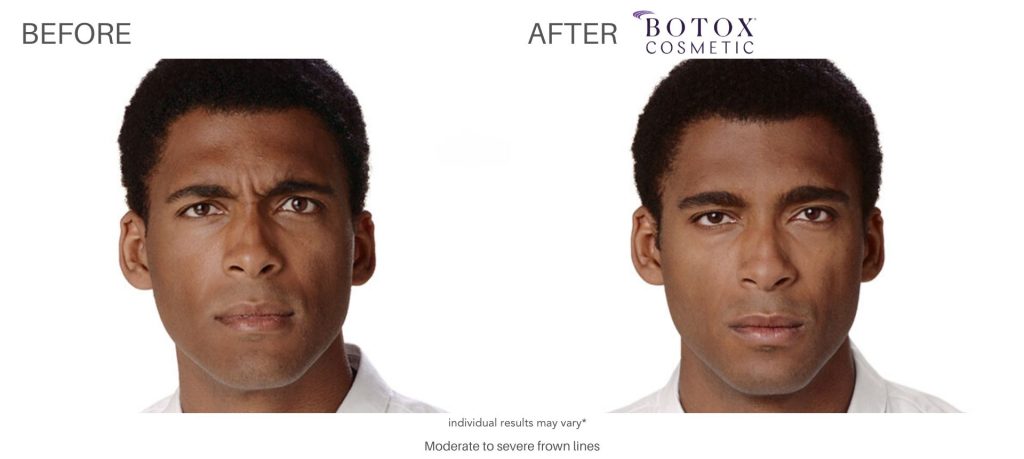 botox_before_and_after_result_numaspa_newportnews_4