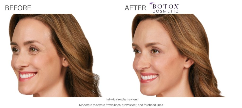 botox_cosmetic_before_and_after_pics_numa_spa_10