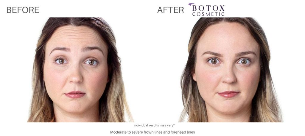 botox_cosmetic_before_and_after_pics_numa_spa_2