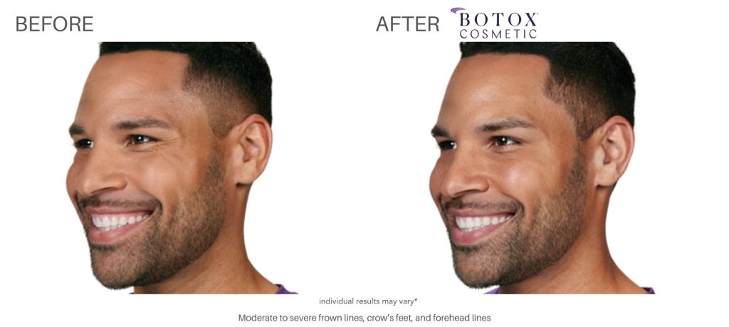 botox_cosmetic_before_and_after_pics_numa_spa_3