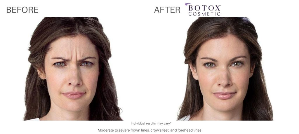 botox_cosmetic_before_and_after_pics_numa_spa_4