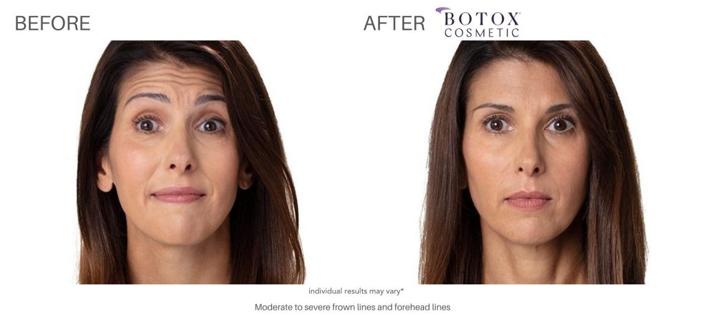 botox_cosmetic_before_and_after_pics_numa_spa_8