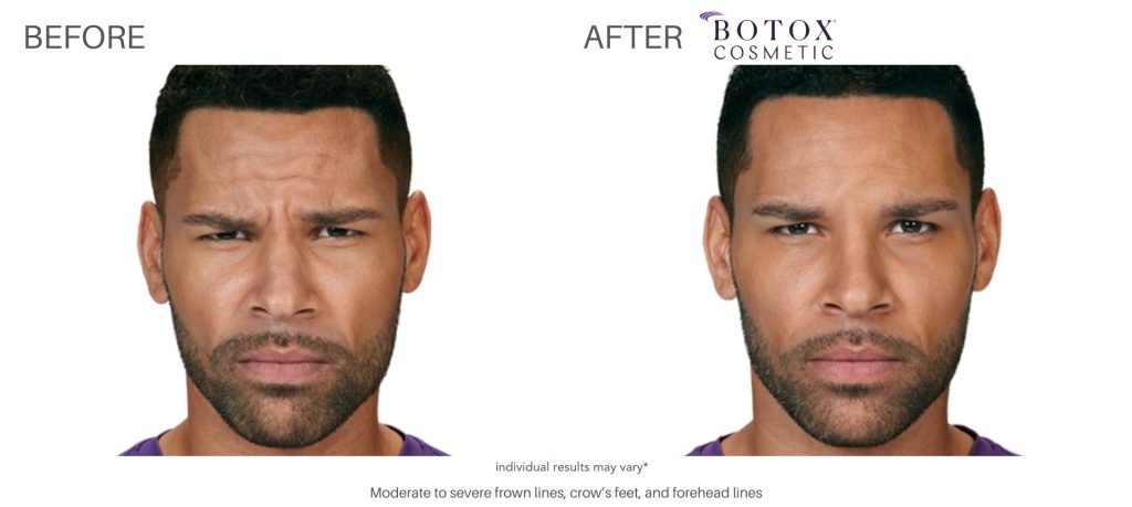 botox_cosmetic_before_and_after_pics_numa_spa_9