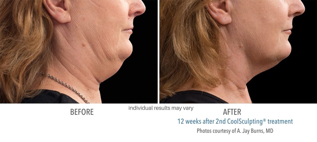 coolsculpting_before_and_after_result_numaspa_1
