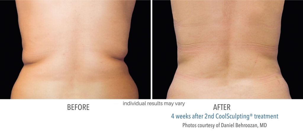 coolsculpting_before_and_after_result_numaspa_11