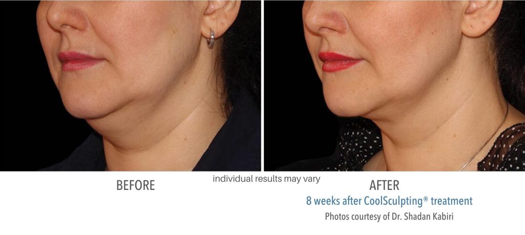 coolsculpting_before_and_after_result_numaspa_12 (1)