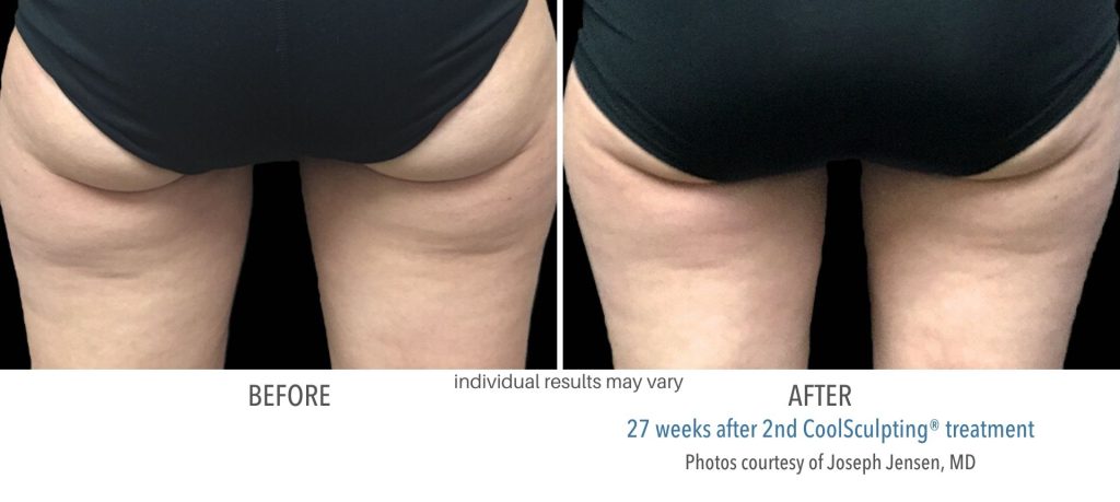 coolsculpting_before_and_after_result_numaspa_13