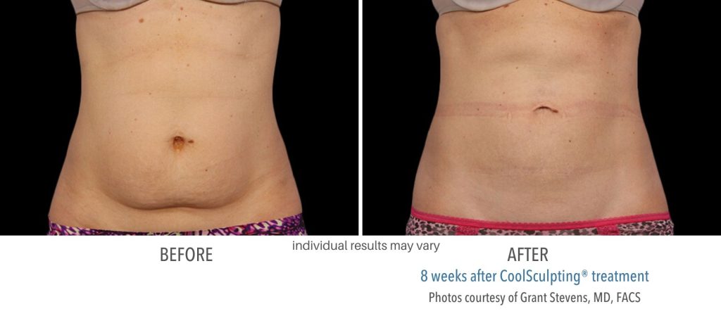 coolsculpting_before_and_after_result_numaspa_2