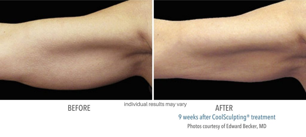 coolsculpting_before_and_after_result_numaspa_4