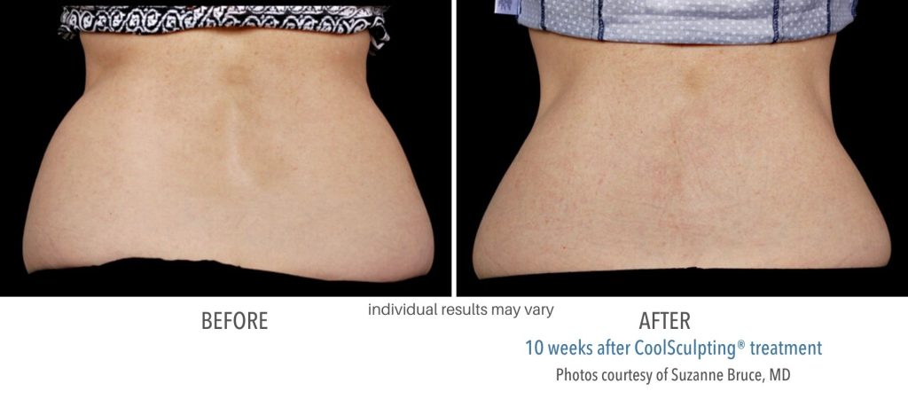 coolsculpting_before_and_after_result_numaspa_5