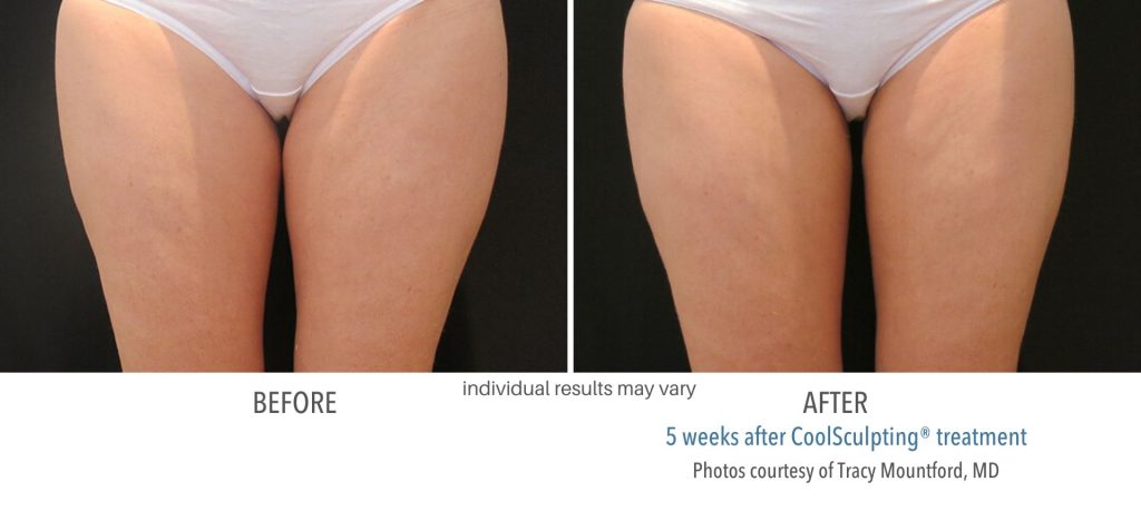 coolsculpting_before_and_after_result_numaspa_7