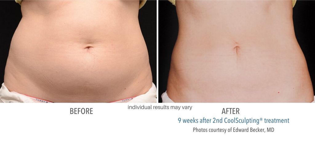 coolsculpting_before_and_after_result_numaspa_9