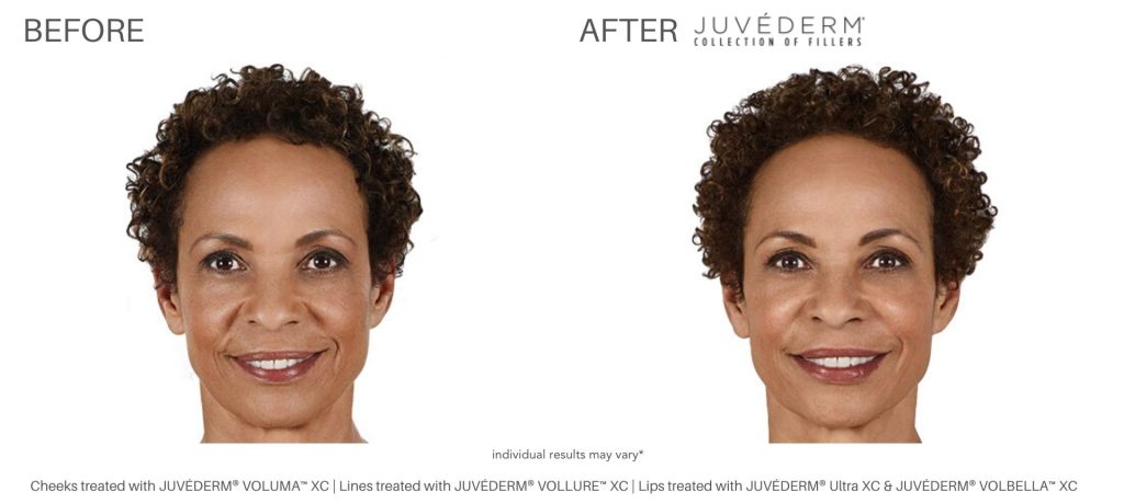 dermal_fillers_before_and_after_numaspa_newportnews_1