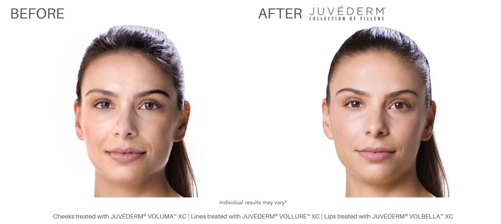 dermal_fillers_before_and_after_numaspa_newportnews_2
