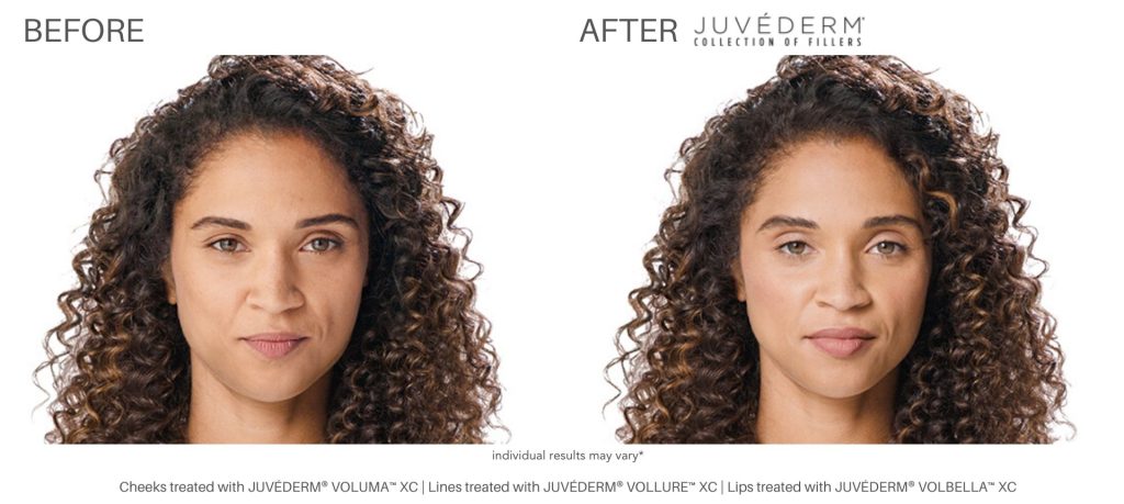 dermal_fillers_before_and_after_numaspa_newportnews_3