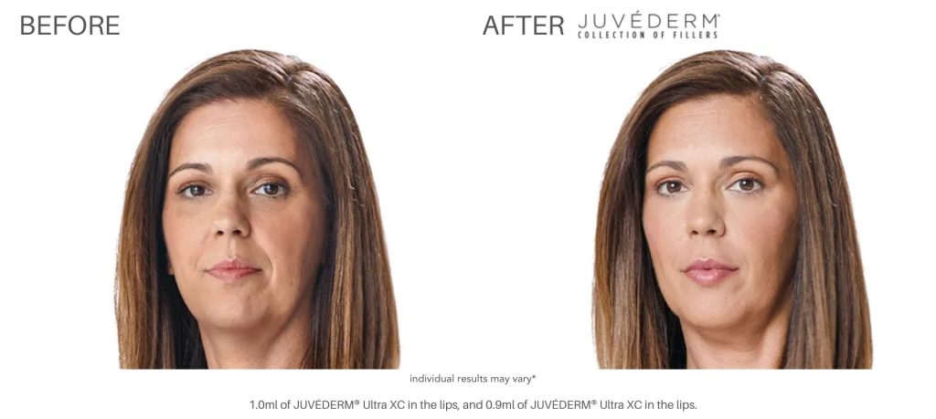 juvderm_before_and_after_pics_numa_spa_1