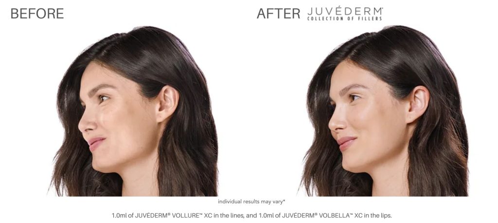 juvderm_before_and_after_pics_numa_spa_3