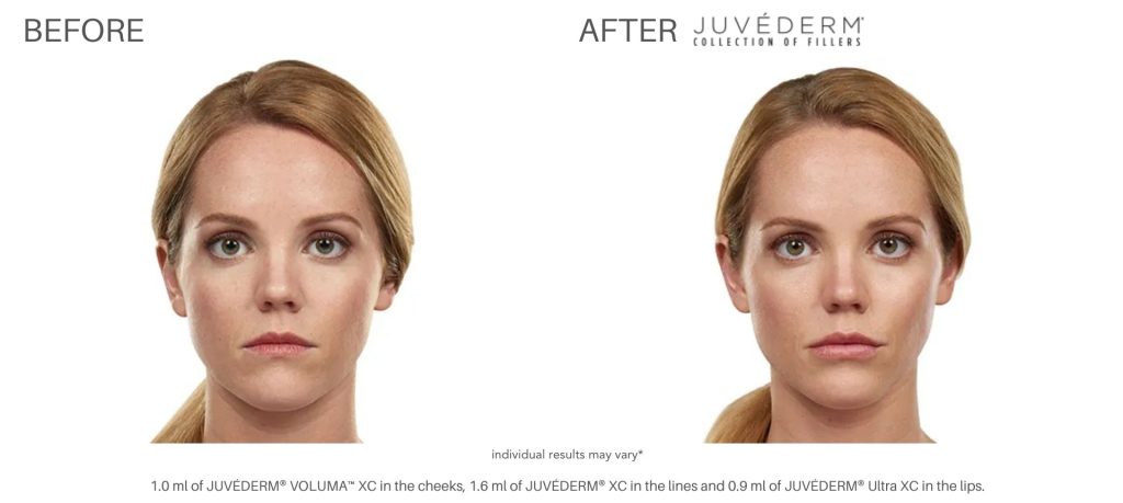 juvderm_before_and_after_pics_numa_spa_5