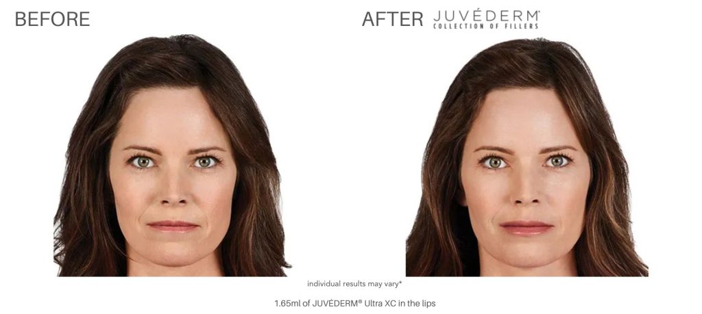 juvderm_before_and_after_pics_numa_spa_6