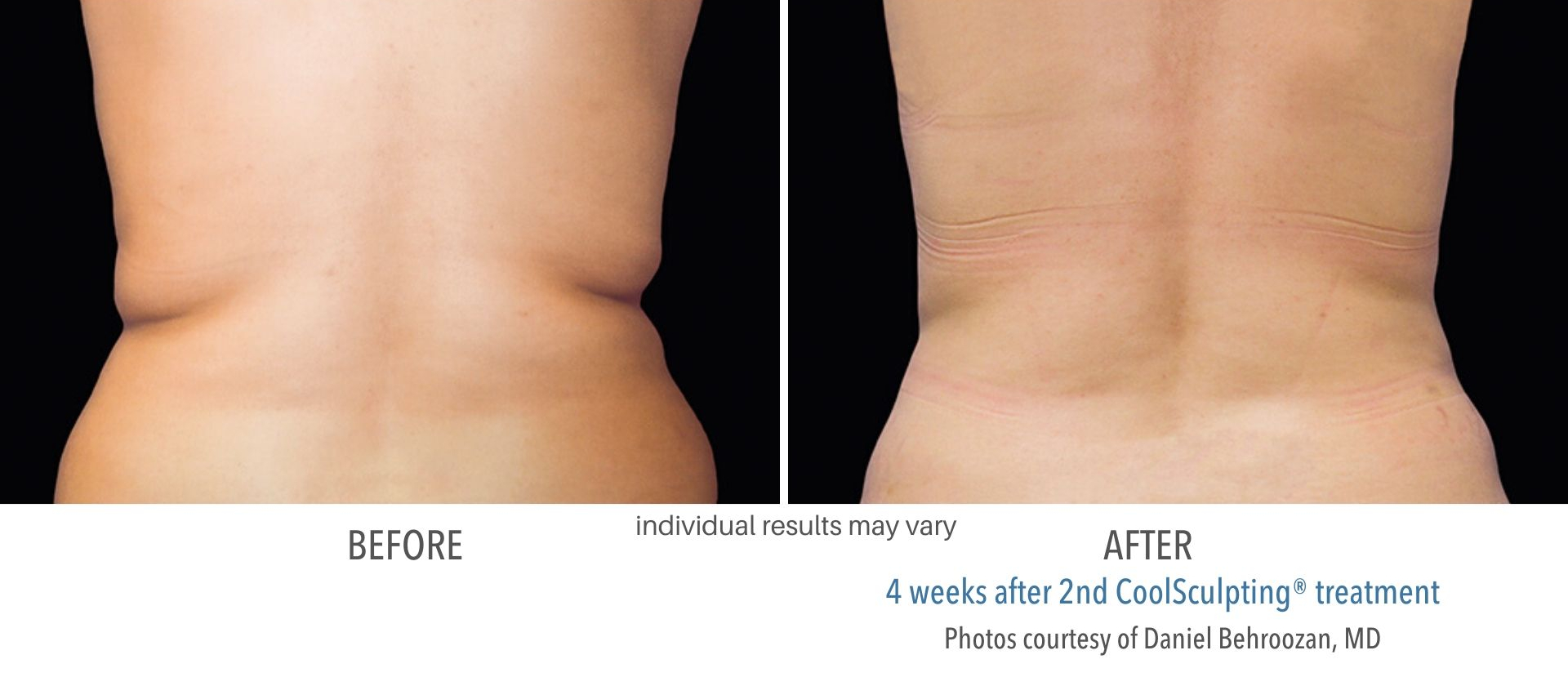 Coolsculpting Before And After Fat Freezing Body Transformations