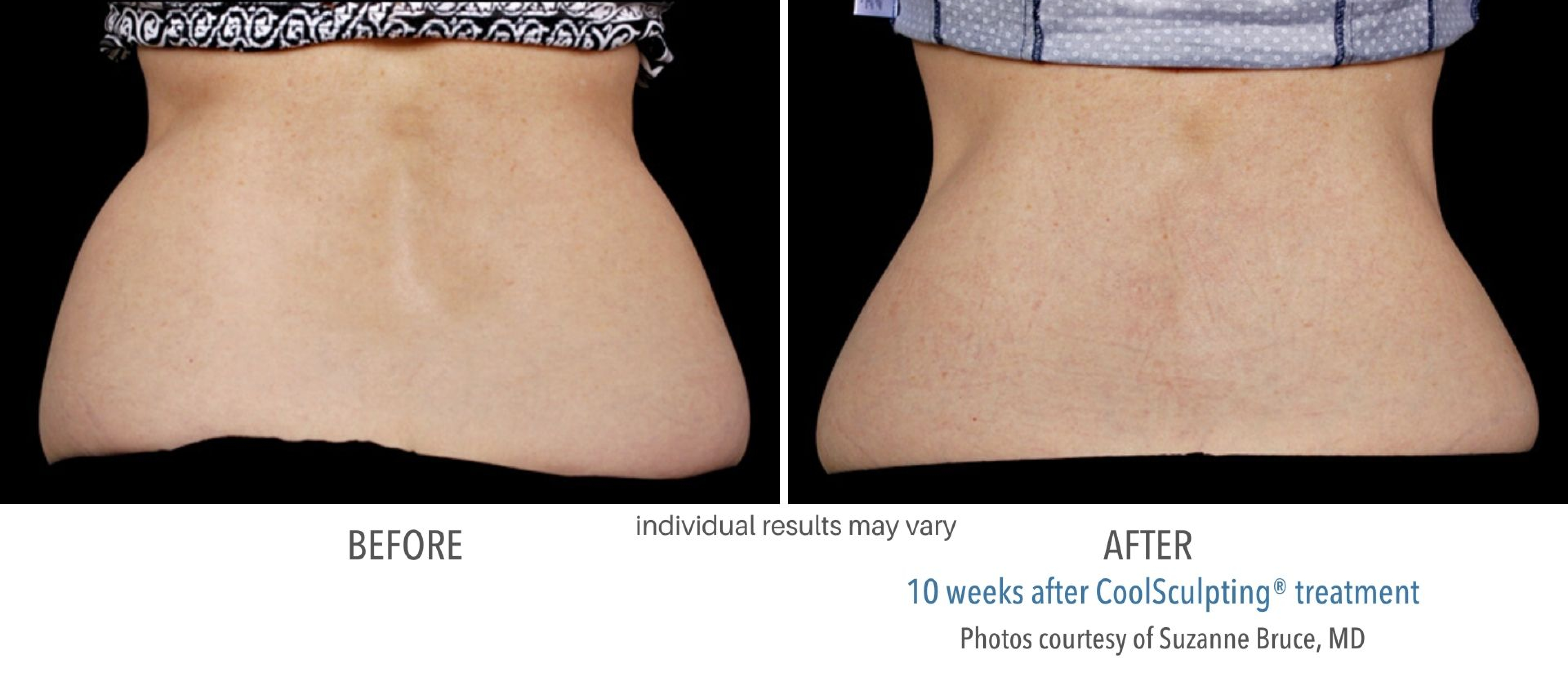 CoolSculpting Before and After Fat Freezing Body Transformations